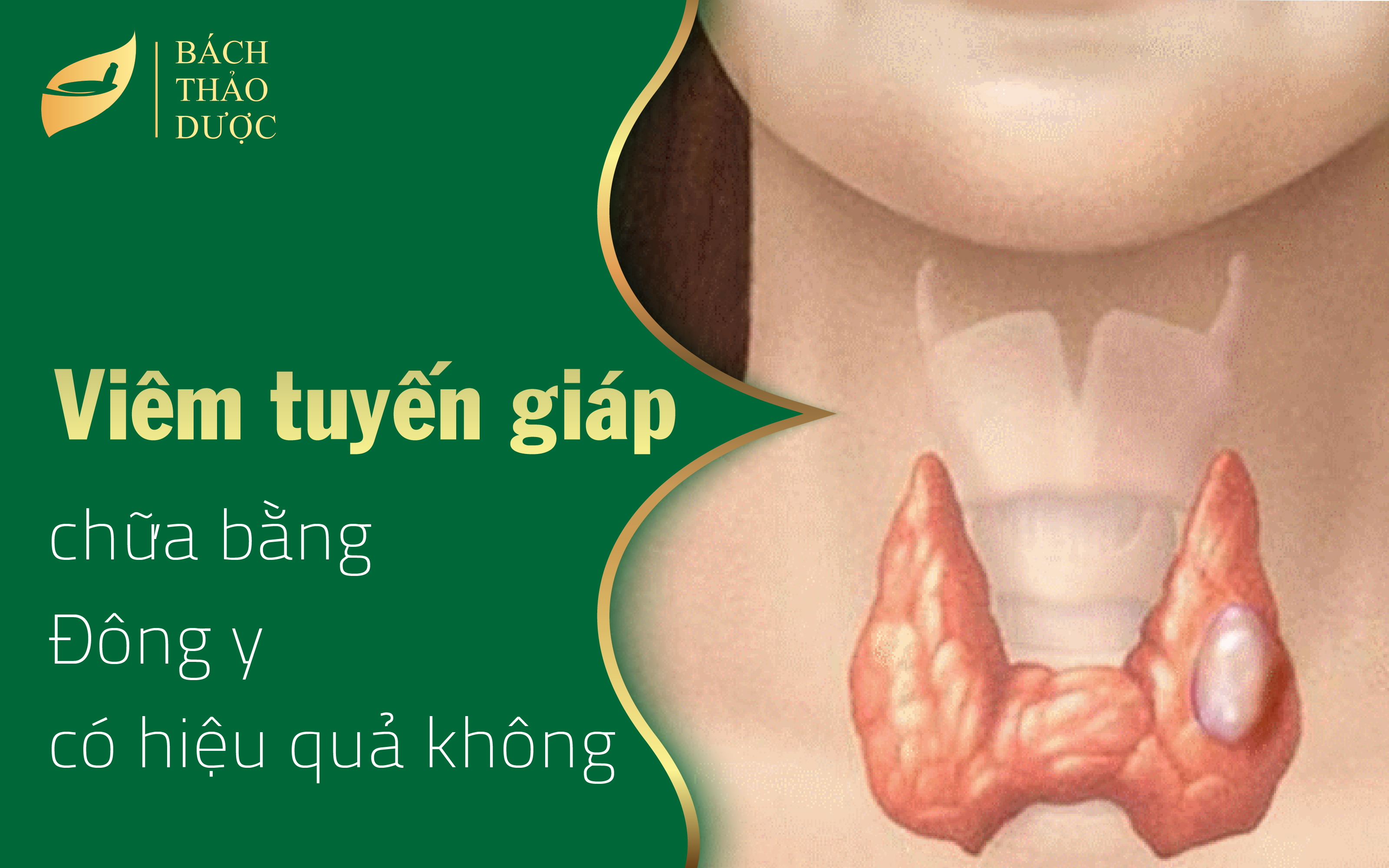 Chữa viêm tuyến giáp bằng thuốc đông y có hiệu quả không?