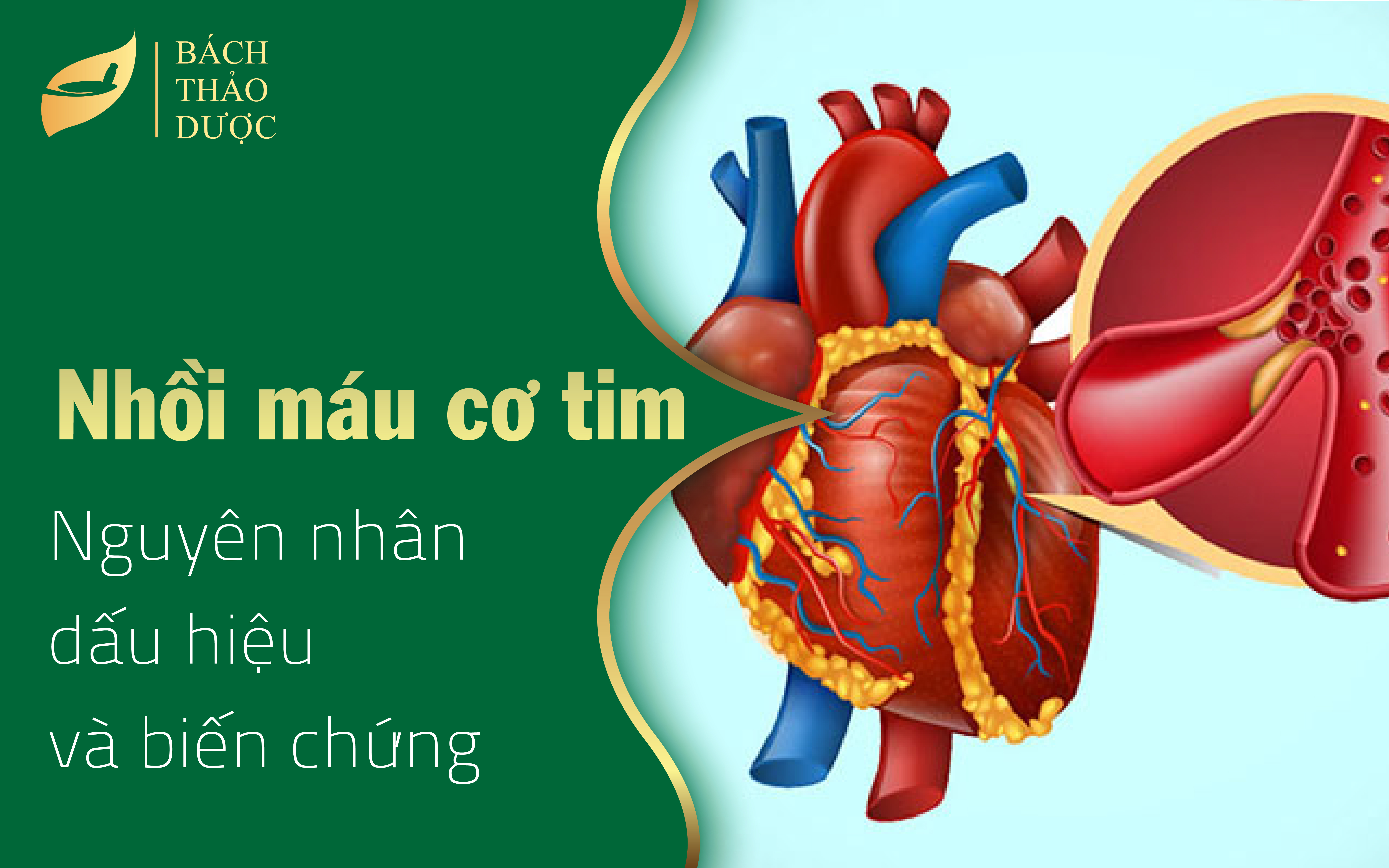 Nguyên nhân, dấu hiệu, biến chứng phổ biến của nhồi máu cơ tim